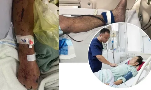 Người đàn ông ở Hưng Yên nguy kịch, tím toàn thân sau chế biến thịt lợn sống, bác sĩ khuyến cáo 3 không