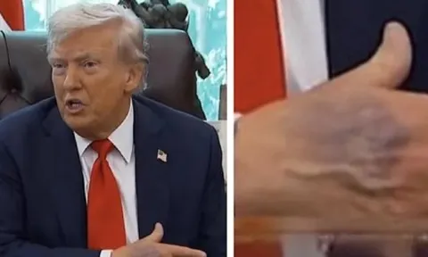 Bàn tay thâm tím của ông Trump gây chú ý