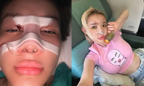 Ngân 98 lạm dụng phẫu thuật thẩm mỹ, hệ quả ra sao?