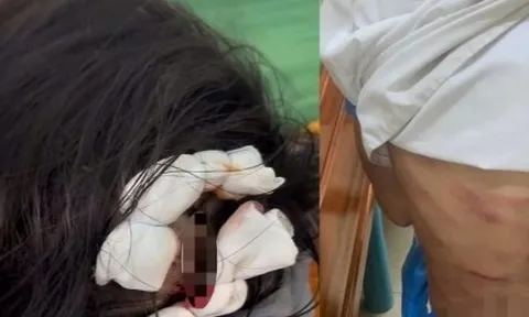 Xác minh vụ bé gái lớp 5 nghi bị cha dượng bạo hành dã man