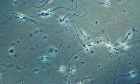 Ca mang thai đầu tiên trên thế giới nhờ phương pháp thu hồi tinh trùng do AI hỗ trợ