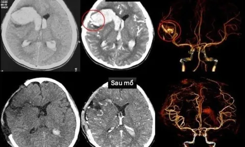 Hy hữu bé gái 13 tuổi bị đột quỵ