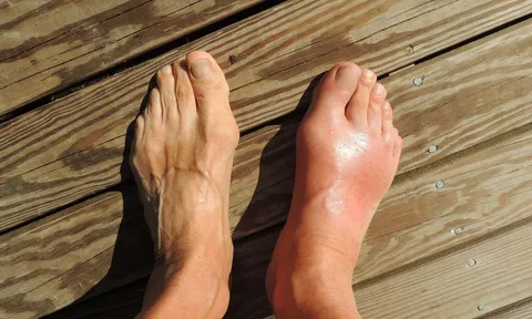 Phương pháp mới hứa hẹn trị cùng lúc bệnh gout và gan nhiễm mỡ