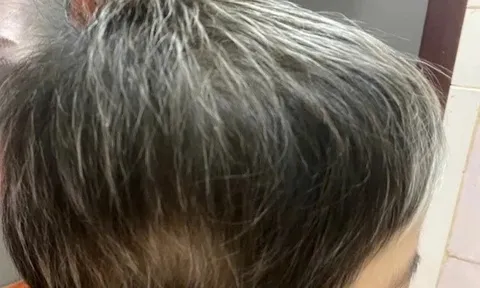 Điều trị thành công cho bệnh nhân 7 tuổi rụng toàn bộ tóc