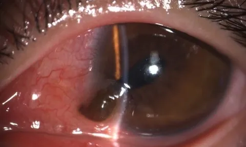 Khẩn cứu người đàn ông bị đinh bắn vào mắt