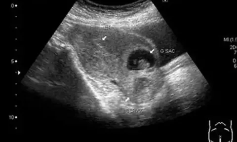 Cấp cứu bệnh nhân tự ý phá thai khi mang thai tại vết mổ cũ