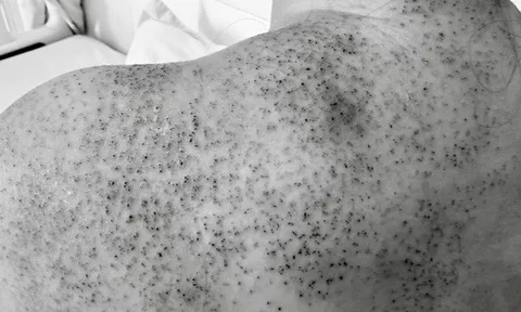 Người phụ nữ nhập viện cấp cứu sau khi chích lể, giác hơi