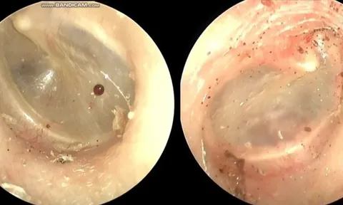 Người phụ nữ 60 tuổi tai ngứa như kim châm, bác sĩ gắp ra thứ "đáng sợ" bên trong
