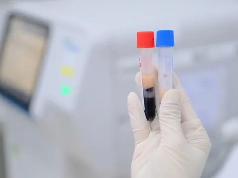 29 tuổi, mỡ máu cao vút dù ăn uống khoa học, cân nặng bình thường: Không ngờ lý do là điều này