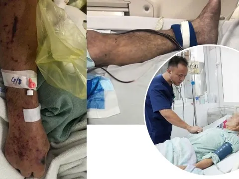 Người đàn ông ở Hưng Yên nguy kịch, tím toàn thân sau chế biến thịt lợn sống, bác sĩ khuyến cáo 3 không