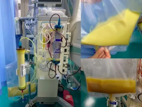 Máu trắng đục như sữa sau khi uống 3 cốc đồ uống này mỗi ngày: Nhiều người mê mẩn