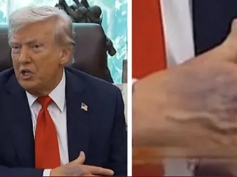 Bàn tay thâm tím của ông Trump gây chú ý