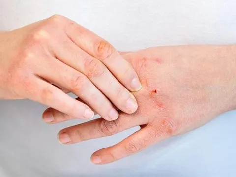 Mưa bão, lụt lội: Cẩn trọng với nguy cơ bỏng và mắc các bệnh về da