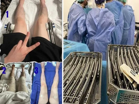 Những hình ảnh đáng sợ về thủ thuật kéo dài chân đang gây sốt toàn cầu