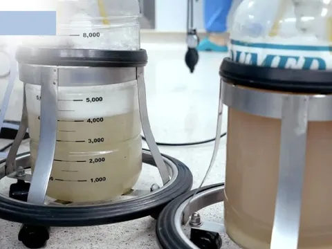 Hút ra gần 30 lít dịch đục "như bùn" từ phổi người đàn ông