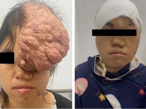 Ngỡ ngàng khuôn mặt cô gái sau 15 năm bị khối u khổng lồ đeo bám