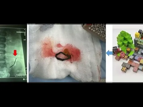 Ớn lạnh phát hiện 20 viên nam châm rỉ sét nằm trong bụng bé trai
