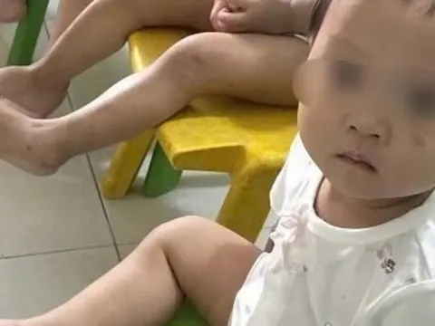 Tình trạng sức khỏe bé gái 1 tuổi bị bầm tím mặt khi gửi nhà trẻ ở Bắc Ninh