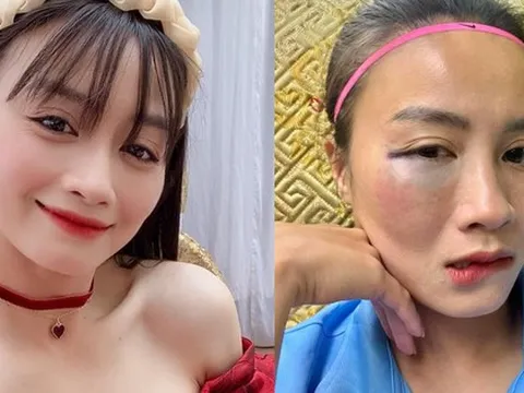 Hotgirl bóng đá Hoàng Thị Loan để lộ vùng mắt sưng vù sau pha va chạm trên sân bóng khiến fan cực xót