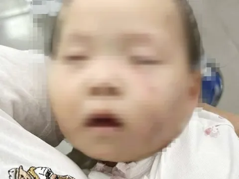 Tạm giữ nữ giáo viên trong vụ bé gái có nhiều vết bầm tím chi chít trên mặt