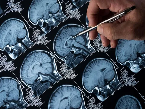 “Amip ăn não” lan rộng tại một bang ở Ấn Độ, tỷ lệ tử vong lên đến 97%