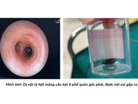 Qua 3 bệnh viện mới phát hiện dị vật - hạt mãng cầu bít phổi bé trai