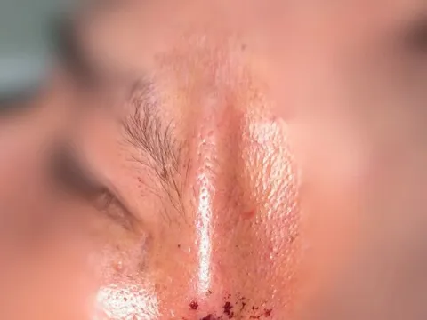 Người đàn ông nhập viện với khúc cây xuyên vào thái dương