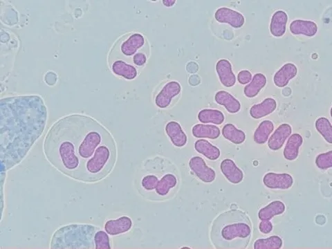 Hà Nội ghi nhận ca mắc não mô cầu là trẻ 11 tuổi, chưa tiêm vaccine