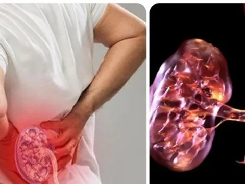 19 dấu hiệu thận yếu bạn không nên bỏ qua