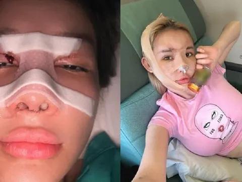Ngân 98 lạm dụng phẫu thuật thẩm mỹ, hệ quả ra sao?