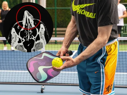 Người đàn ông TP.HCM gãy xương mũi vì chơi Pickleball