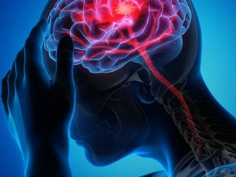 Hơn 99% các cơn đột quỵ và nhồi máu cơ tim liên quan 4 điều này