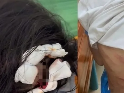 Xác minh vụ bé gái lớp 5 nghi bị cha dượng bạo hành dã man