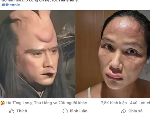 H'Hen Niê tiết lộ bị nổi mề đay sau sinh, bác sĩ nói gì về tình trạng này?