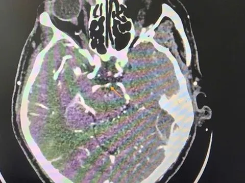 Đột quỵ khi uống bia, người đàn ông thoát chết ngoạn mục