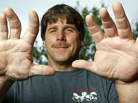 Người đàn ông sở hữu bàn tay to bất thường, sự thật phía sau khiến tất cả kinh ngạc