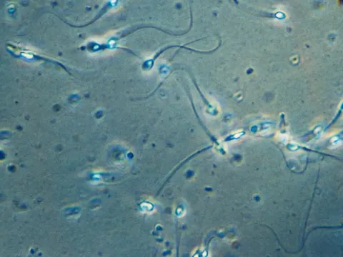 Ca mang thai đầu tiên trên thế giới nhờ phương pháp thu hồi tinh trùng do AI hỗ trợ