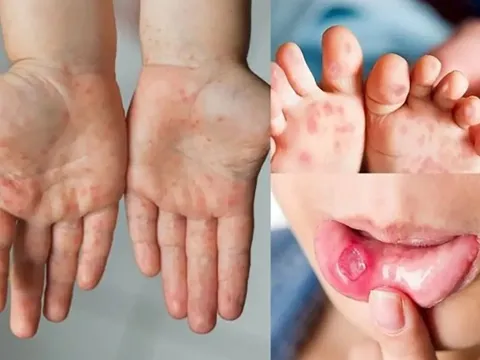 Nguy cơ dịch chồng dịch ở TP.HCM, ghi nhận hơn 3.000 ca một tuần