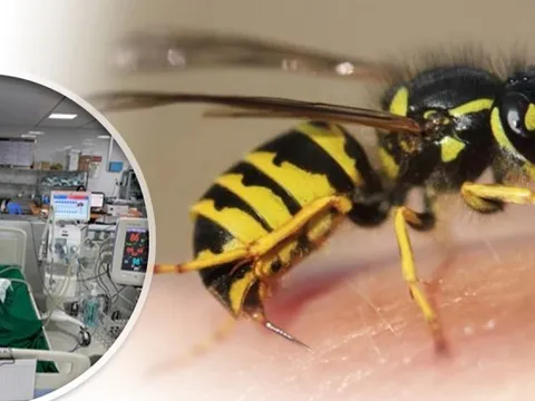 Bé gái 9 tuổi nguy kịch vì bị đàn ong vò vẽ đốt hơn 50 nốt