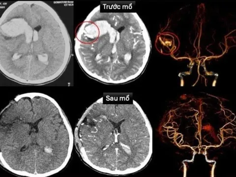 Hy hữu bé gái 13 tuổi bị đột quỵ