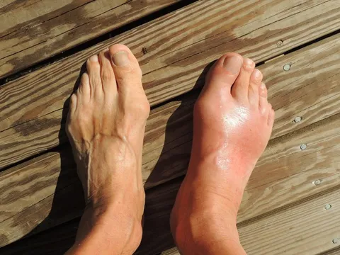 Phương pháp mới hứa hẹn trị cùng lúc bệnh gout và gan nhiễm mỡ