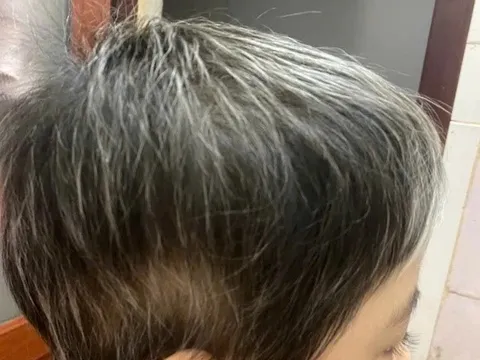 Điều trị thành công cho bệnh nhân 7 tuổi rụng toàn bộ tóc