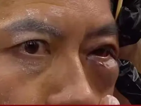 Võ sĩ Trung Quốc nguy cơ thương tật mắt vĩnh viễn khi bị hạ đo ván ở nước ngoài