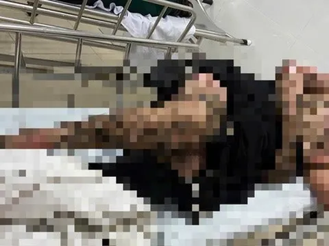 Bị bỏng toàn thân khi quăng câu vướng vào dây điện