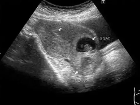 Cấp cứu bệnh nhân tự ý phá thai khi mang thai tại vết mổ cũ