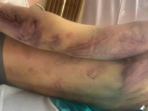 Tạm giữ 8 người liên quan đến vụ học viên 17 tuổi tử vong tại trung tâm công tác xã hội