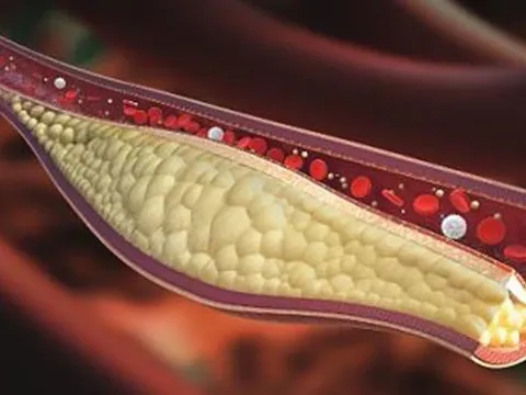 Máu nhiễm mỡ nguy hiểm thế nào?