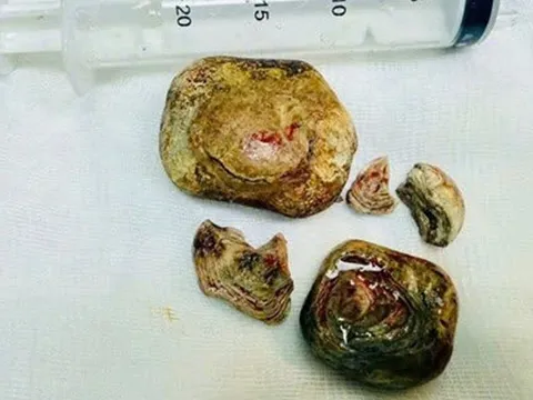 Người đàn ông 43 tuổi "bụng cứng như đá", bác sĩ phát hiện bí mật "đáng sợ"