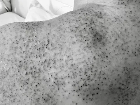 Người phụ nữ nhập viện cấp cứu sau khi chích lể, giác hơi