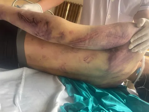 Bộ Y tế yêu cầu rà soát các cơ sở trợ giúp xã hội sau vụ học viên tử vong ở Quảng Ninh